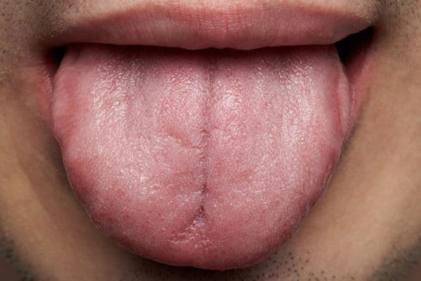 'Sore tongue' and 'fatigue' among symptoms of overlooked deficiency, doctor warns