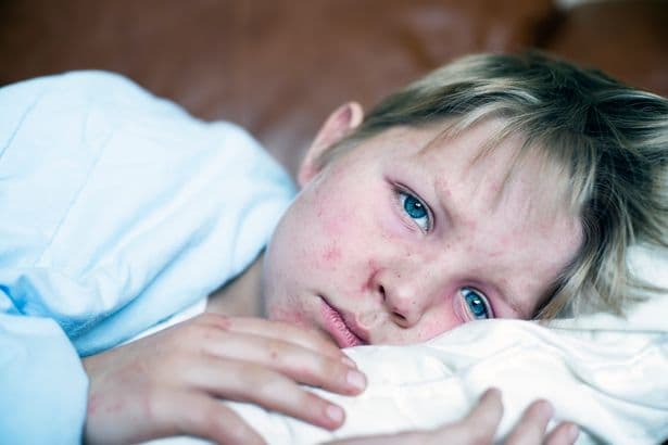 Measles outbreak: All you need to know as UK cases rise