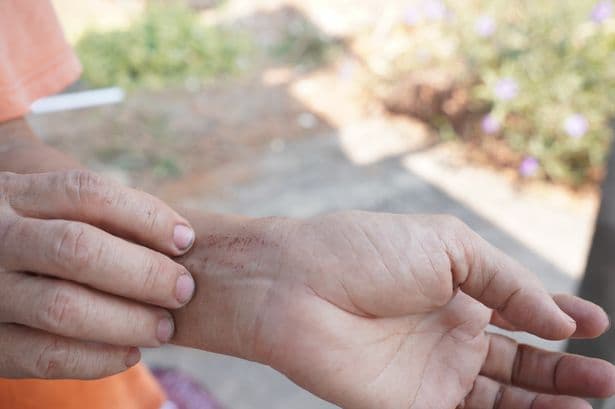 NHS says 'itchy skin' with other key signs could indicate cancer