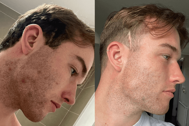 Man 'literally wouldn't go out' until nurse nan sent him 'local formula' for skin